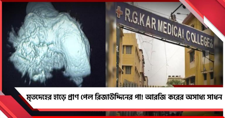 মৃতদেহের হাড়ে প্রাণ পেল রিজাউদ্দিনের পা! আরজি করের অসাধ্য সাধন