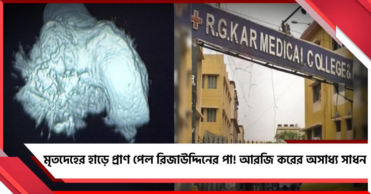 মৃতদেহের হাড়ে প্রাণ পেল রিজাউদ্দিনের পা! আরজি করের অসাধ্য সাধন
